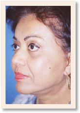 After Photo of Brow Lift