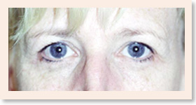 Before Photo of Brow Lift