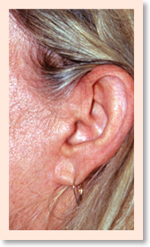 Close-up of facelift incision in front of the ear