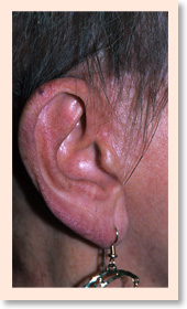Close-up of facelift incision in front of the ear