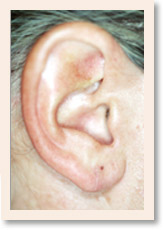 After Photo of Torn Earlobe Repair