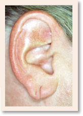 Before Photo of Torn Earlobe Repair