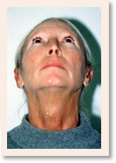 After Photo of Otoplasty (Front)