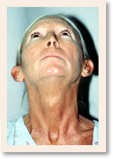 Before Photo of Otoplasty (Front)