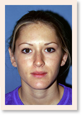 Photo of Otoplasty - After