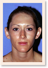 Photo of Otoplasty - Before