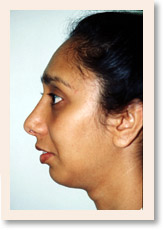 After Photo of Rhinoplasty