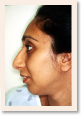 Before Photo of Rhinoplasty