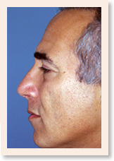 After Photo of Rhinoplasty