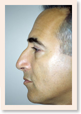 Before Photo of Rhinoplasty