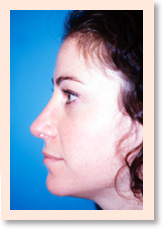 After Photo of Rhinoplasty