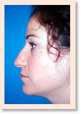 Before Photo of Rhinoplasty