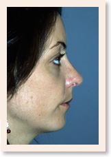 After Photo of Rhinoplasty