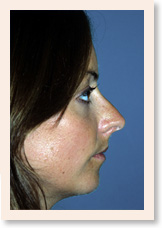 Before Photo of Rhinoplasty