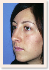 After Photo of Rhinoplasty