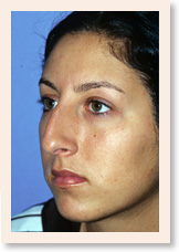 Before Photo of Rhinoplasty