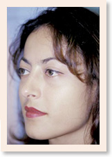 After Photo of Rhinoplasty