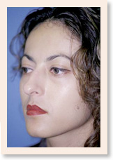 Before Photo of Rhinoplasty