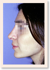 After Photo of Rhinoplasty