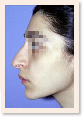 Before Photo of Rhinoplasty