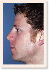 After Photo of Rhinoplasty