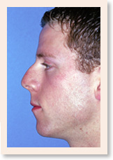 Before Photo of Rhinoplasty